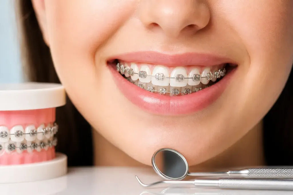 Fixed Braces